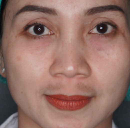 Before/After Image